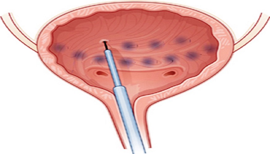 Botox for Urinary Incontinence